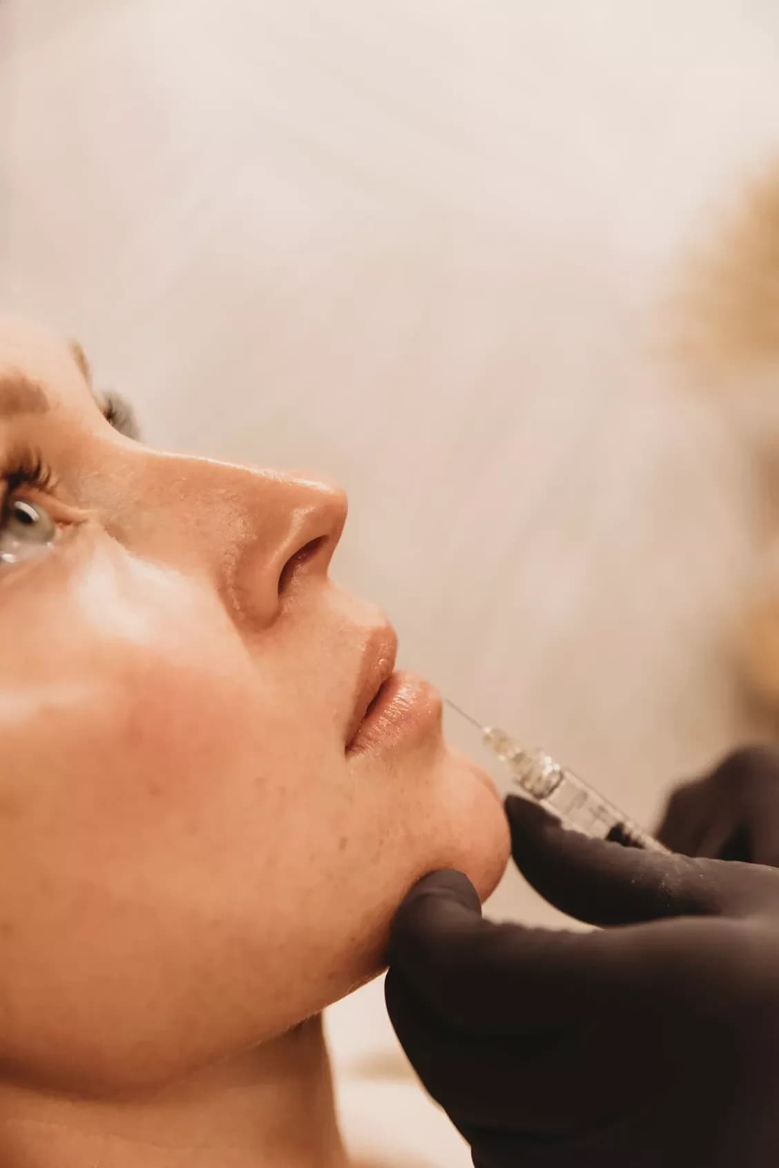 Lip Filler