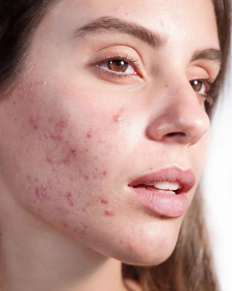 Acne Control
